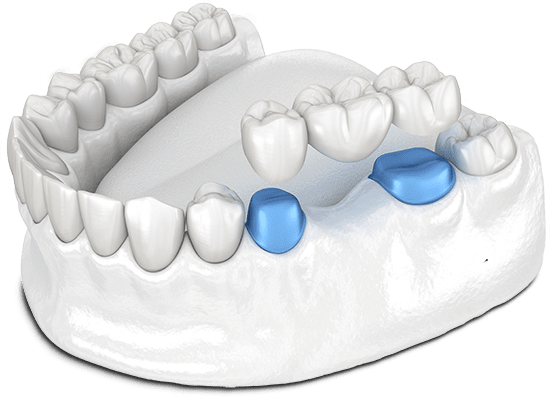 dental-bridge-model.png