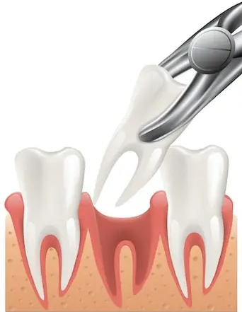 Tooth-Extraction (1).jpg
